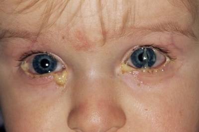 У ребенка насморк и гноятся глаза: причины и лечение