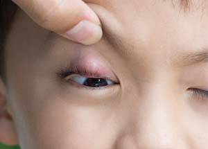 Причины появлении мешков под глазами у ребенка