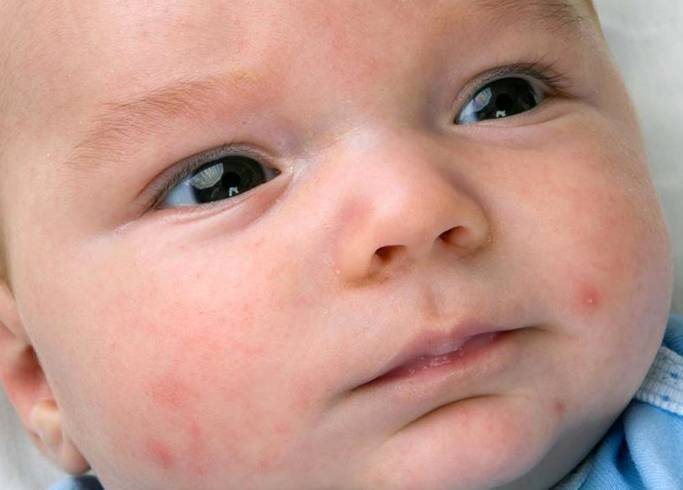Аллергия на лице у ребенка