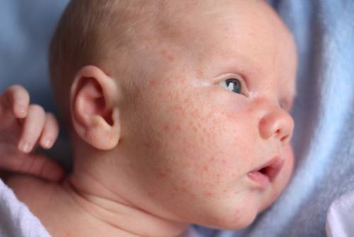 Температура и сыпь у ребенка: причины и лечение заболевания