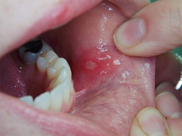 У ребенка болит язык: причины, сопутствующие симптомы, лечение