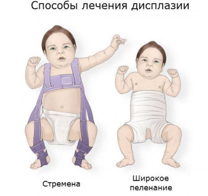 Дисплазия тазобедренного сустава у новорожденных (33 фото): что это такое, как лечить детей до года, узи при незрелости и недоразвитости