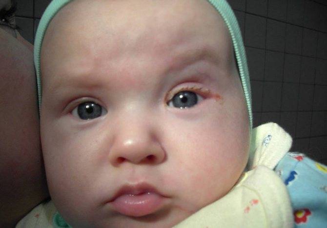 Непроходимость слезного канала (дакриоцистит) - стр. 8 - запись пользователя пичуга (pichuga) в сообществе здоровье новорожденных в категории болезни глаз - babyblog.ru