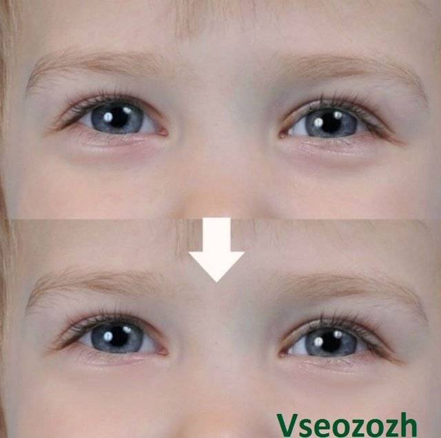 Если у ребенка под глазами синие круги. круги под глазами у ребенка: причина и методы лечения.