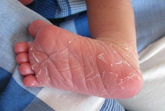 Облазит кожа на пальцах рук у ребенка