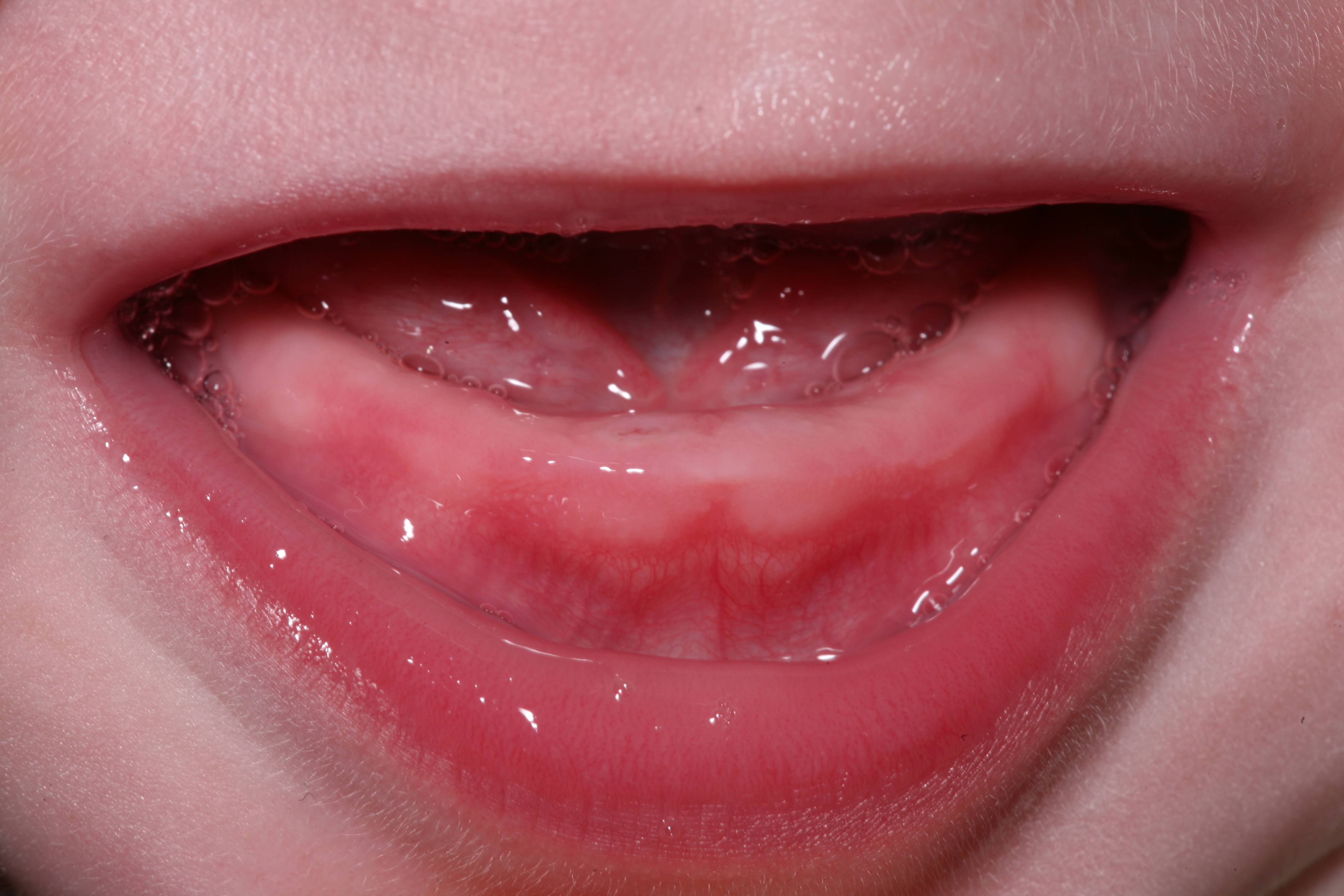 Прорезывание первых зубов у грудничка: признаки, сроки, как помочь, могут ли быть осложнения