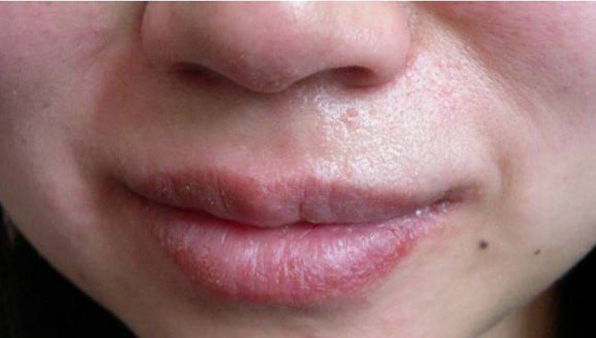 Заеды в уголках рта у детей: причины и лечение, чем можно мазать и как вылечить заболевание