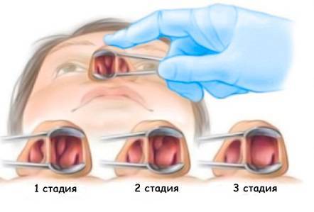 Полипы в носу у ребенка: фото наростов, симптомы, причины и лечение
