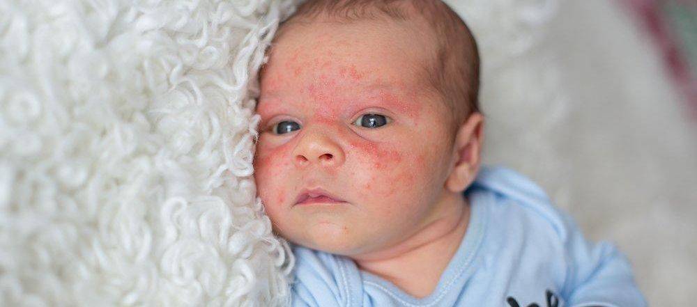 Это акне новорожденных или нет? у кого было подобное? - акне новорожденных комаровский - запись пользователя василиса (avorozoleb) в сообществе здоровье новорожденных в категории высыпания на коже - babyblog.ru