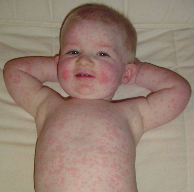 Сыпь на спине у ребенка (20 фото): причины красных высыпаний - пояснения