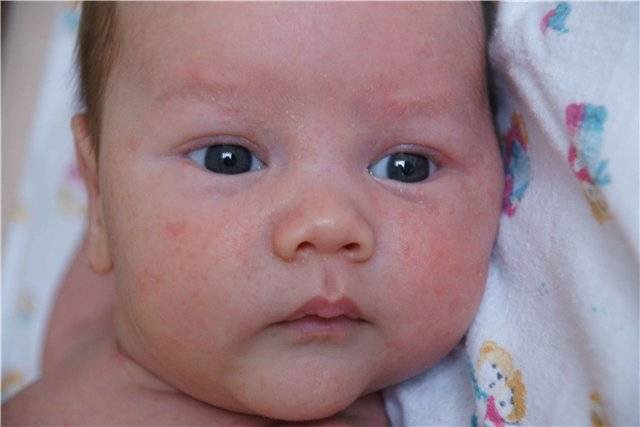 Причины появления родовых пятен (послеродовых) у новорожденных: когда проходят и как ускорить процесс исчезновения