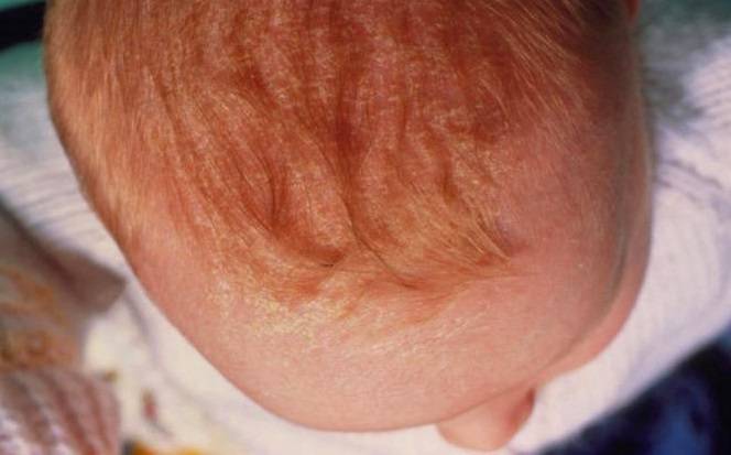 Что делать, если у ребенка сухая кожа головы?