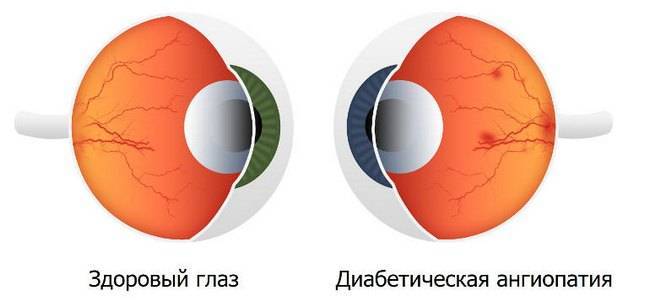 Ангиопатия сетчатки глаза у ребенка: проявления и лечение