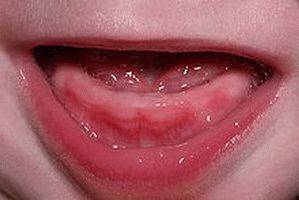 Во сколько месяцев обычно режутся зубки у мальчиков