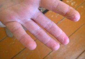 Что делать, если облазит кожа на пальцах рук у ребенка
