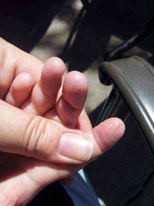 Шелушится кожа на пальцах рук: причины и лечение