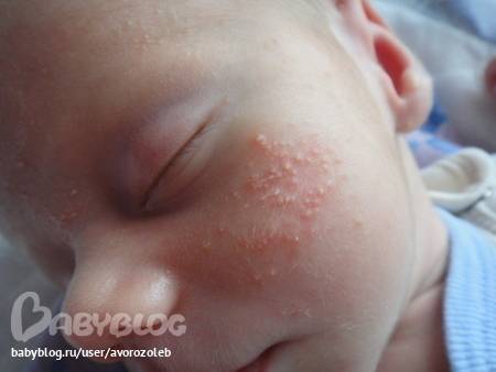 Сыпь: аллергия или цветение новорожденного?