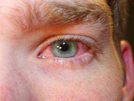 Что делать, если у вас лопнул сосуд в глазу? капли для устранения симптома