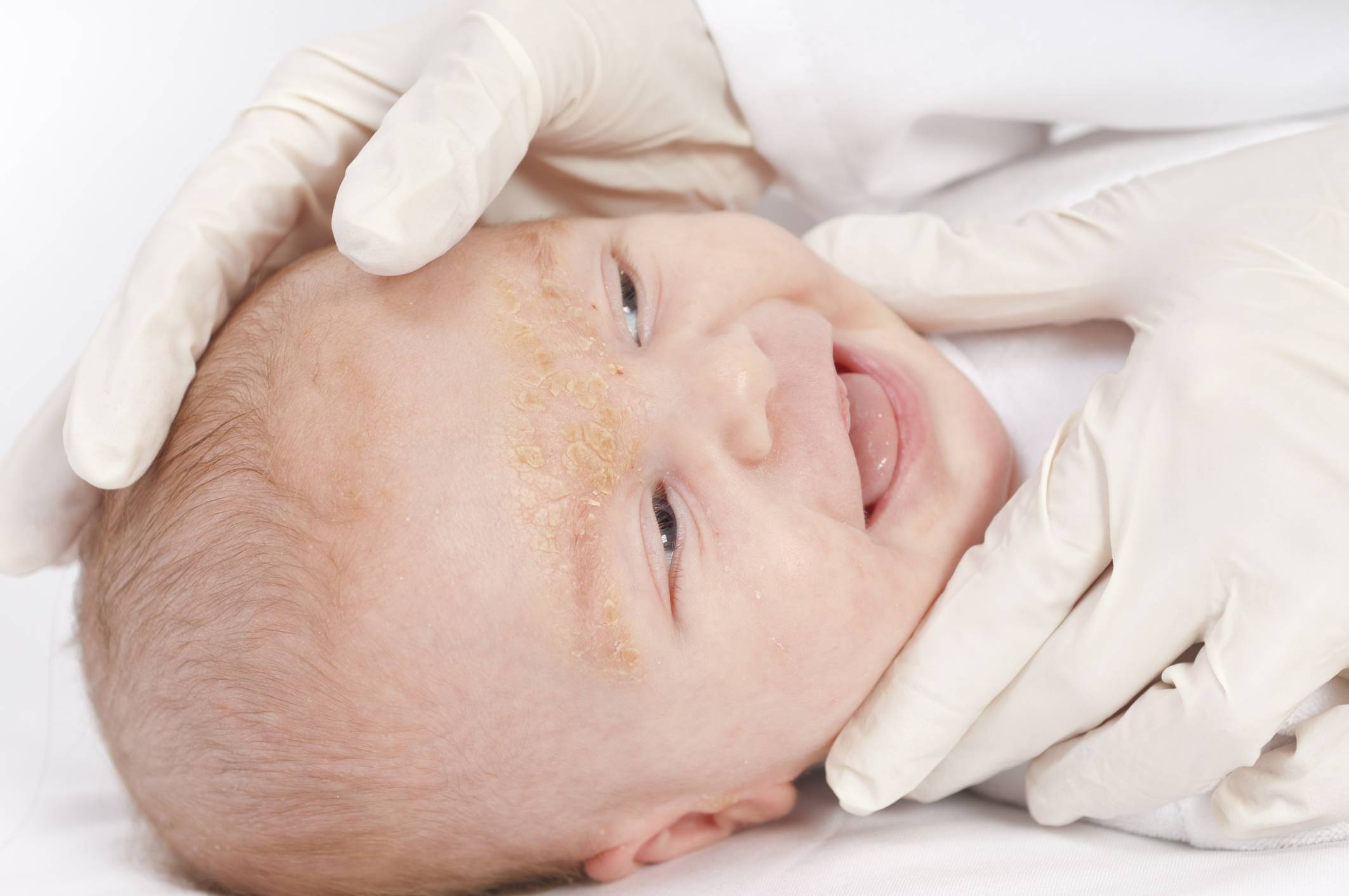 Аллергия на памперсы!? - запись пользователя олеся (id1429679) в сообществе здоровье новорожденных в категории аллергия - babyblog.ru