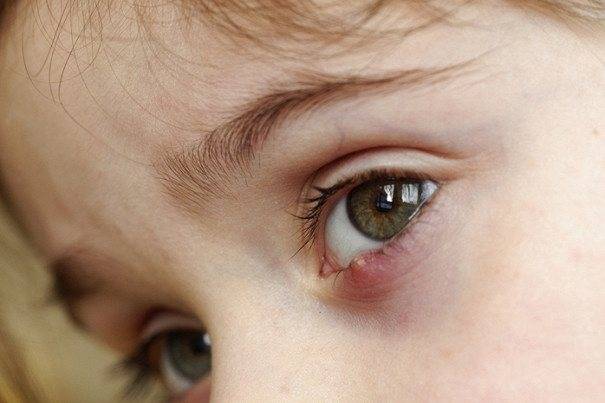 Причины отека под глазом у ребенка и методы его лечения