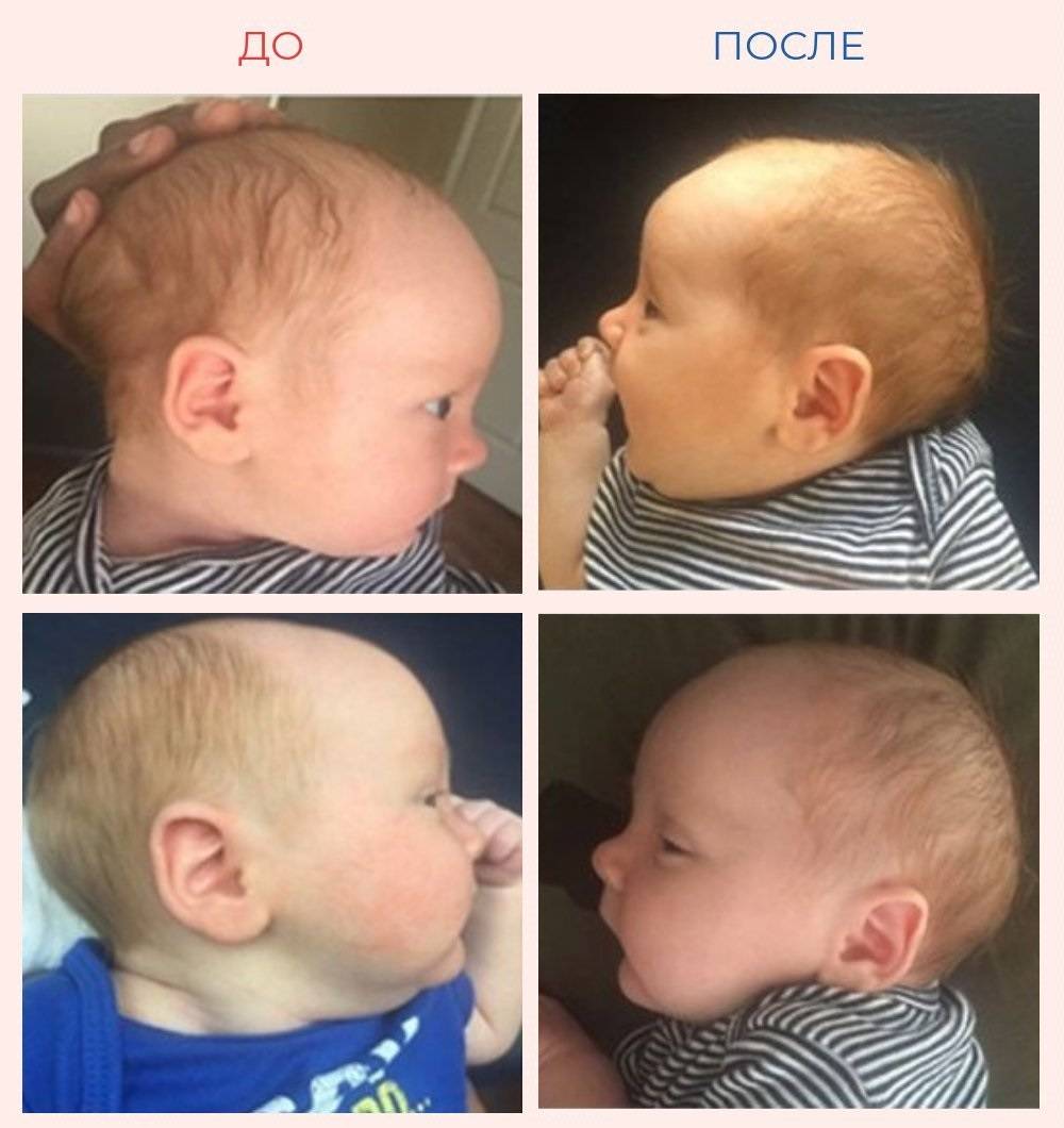 Неровная голова в 2 месяца( - запись пользователя anastasia (id1127961) в сообществе здоровье новорожденных в категории рахит и его профилактика - babyblog.ru