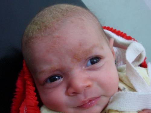 Корочки на голове у новорожденного.. - корочка на голове у грудничка как убрать - запись пользователя monic (monic) в дневнике - babyblog.ru