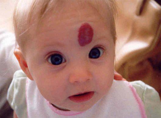 Краснота под глазами у ребенка: причины появления красноты и пятен