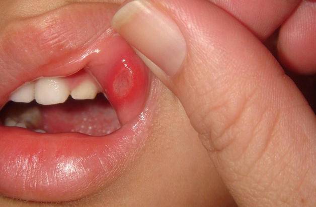 Чем лечить болячки в носу у ребенка