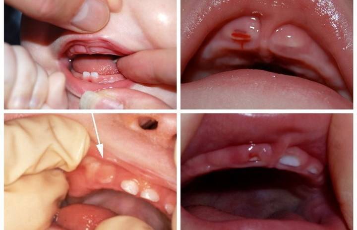 Какие основные признаки прорезывания зубов у грудничка в 4 месяца