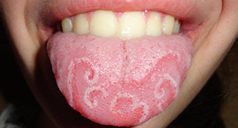 Язвочки во рту: причины появления и способы лечения