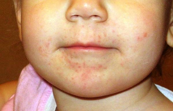 Сыпь вокруг рта у ребенка, раздражение (22 фото): причины высыпаний возле рта, сыпь при ротовирусе