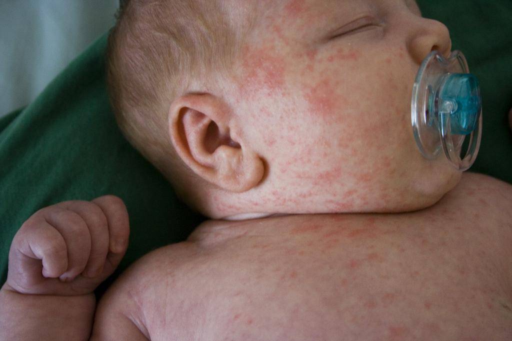Как определить на что аллергия у ребенка, лечение аллергии у ребенка.
