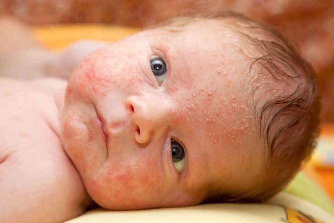 Температура и сыпь у ребенка: что означает данная симптоматика у детей