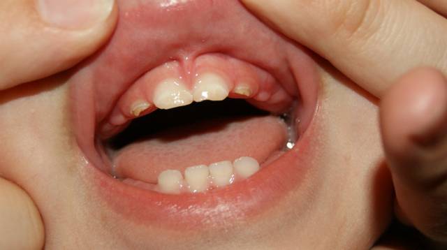 Насморк, сопровождающий появление зубов