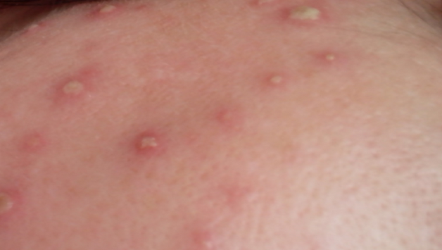 Пузырьки на коже у ребенка. причины, лечение, профилактика : timerule