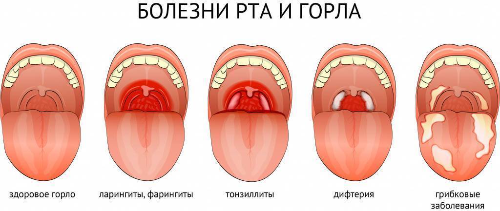 Красное горло у грудничка — как определить и лечение