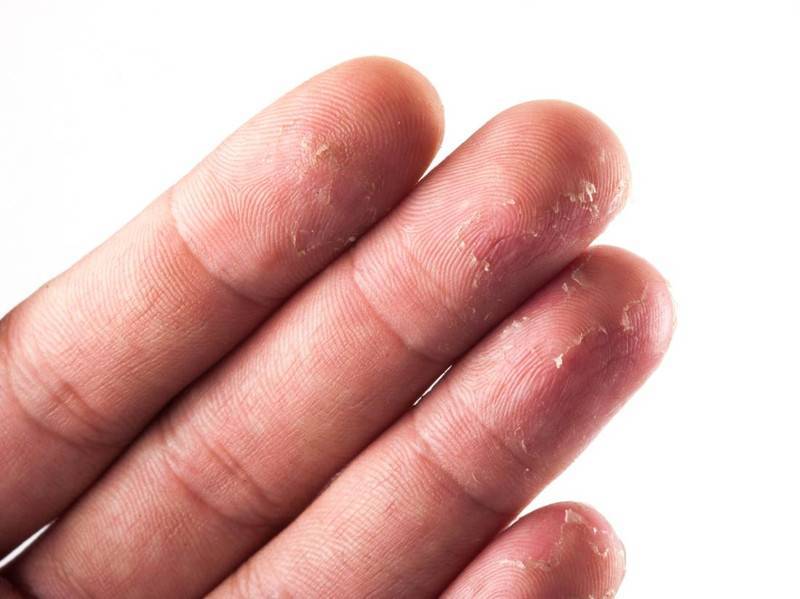 Облазит кожа на пальцах рук у ребенка: на подушечках, между пальцами