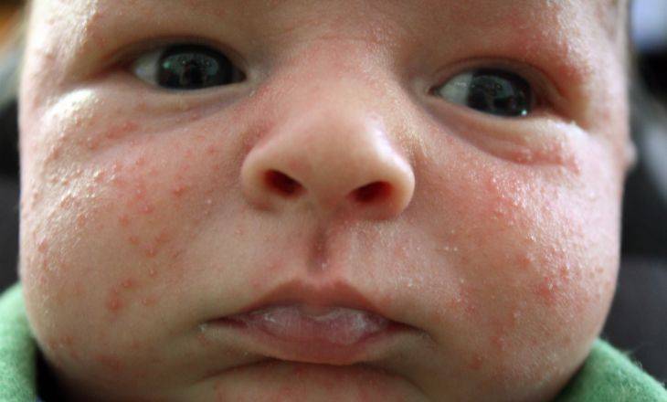 Сыпь аллергическая или трехнедельная сыпь новорожденных?