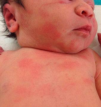 Прыщи на лице у новорожденного, на теле (24 фото): гормональные прыщи в месяц, белые и красные у грудничка