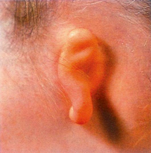 Кровь из уха у новорожденного. что бывает у ребенка