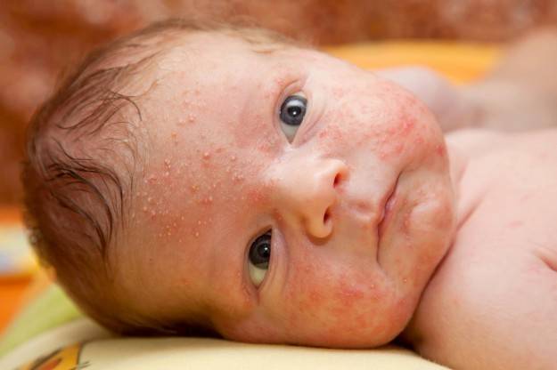 9 причин появления водянистых пузырьков у ребенка на коже