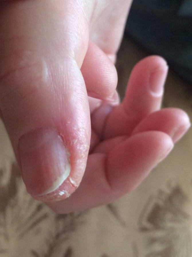 Шелушатся кончики пальцев на руках у ребенка причины и лечение