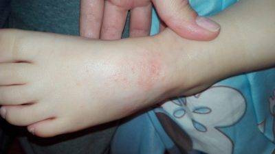 Непонятные прыщики на коленях - прыщи у ребенка - запись пользователя ренька (id1653757) в сообществе бережная защита от инфекций в категории диатез, аллергия, дерматит - babyblog.ru