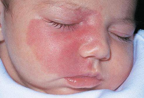 Высыпания новорожденных – что это.   гормональная сыпь у новорожденных | метки: грудничок, лицо