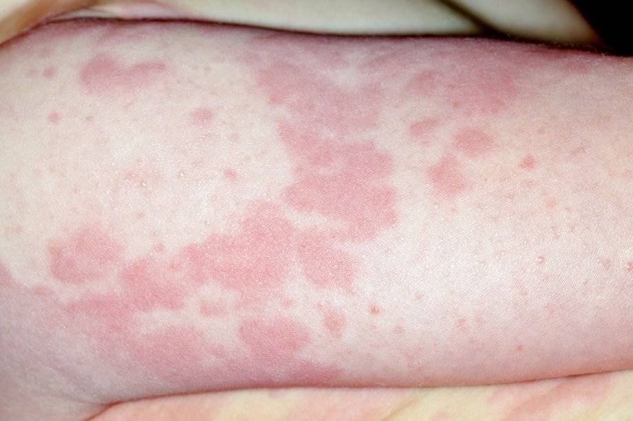 Сыпь на теле у ребенка фото с пояснениями. аллергическая сыпь у детей фото без температуры.