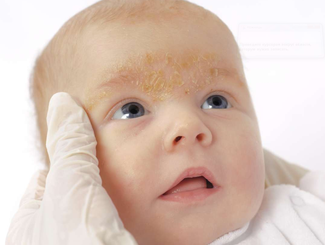 Высыпания новорожденных – что это.   гормональная сыпь у новорожденных | метки: грудничок, лицо