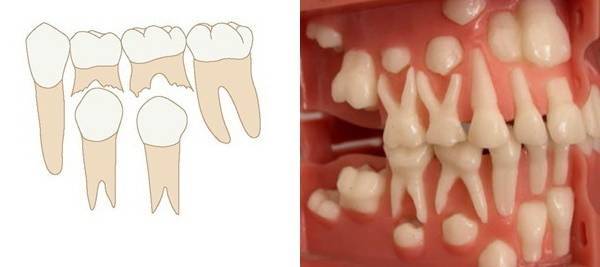 Порядок прорезывания зубов