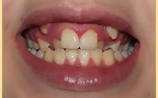 Сколько молочных зубов у детей: сроки прорезывания зубов у детей: когда и сколько?