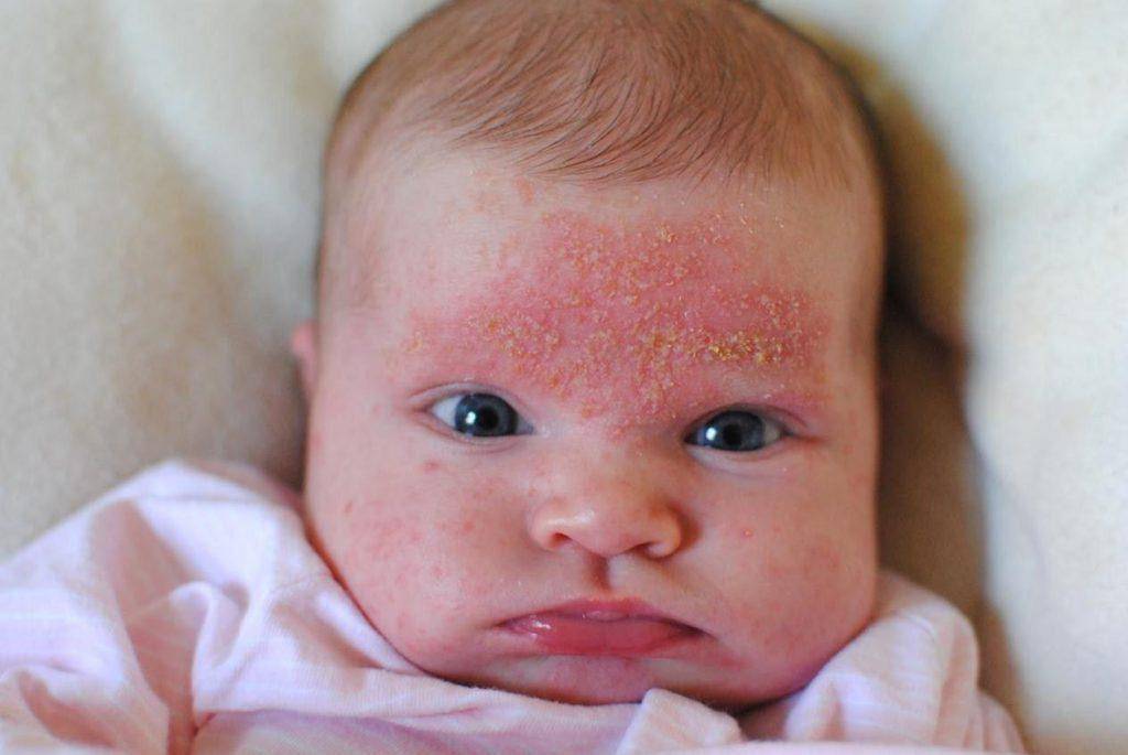 Сыпь: аллергия или цветение новорожденного? - аллергия или цветение новорожденных - стр. 2 - запись пользователя арина (id975551) в сообществе здоровье новорожденных в категории высыпания на коже - babyblog.ru