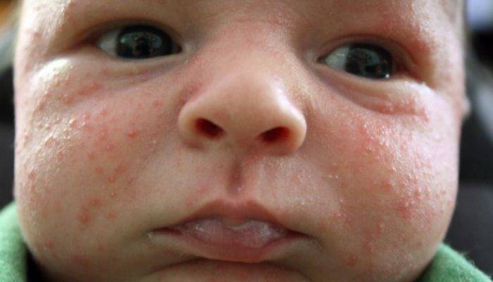 Шершавая кожа у ребенка на руках, ногах, теле — возможные причины